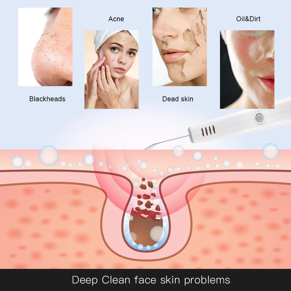 Éclatelle Supersonic Skin Scrubber – Deep-Cleansing Pro Device for Home Use