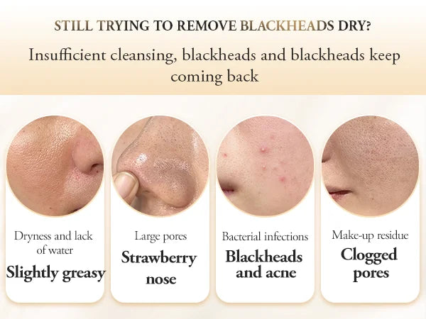 Éclatelle HydroClea Portable Blackhead Remover – Deep Pore Vacuum Cleanser